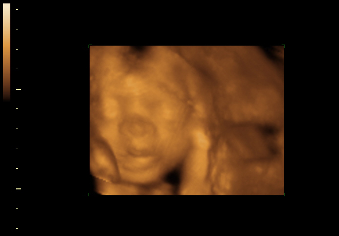 3D ultrasound image at 25 weeks